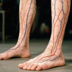 Jakie są przeciwwskazania do presoterapii?